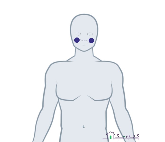 بادکش گونه